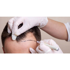 Hair Transplant in Delhi - Amo, IN, USA